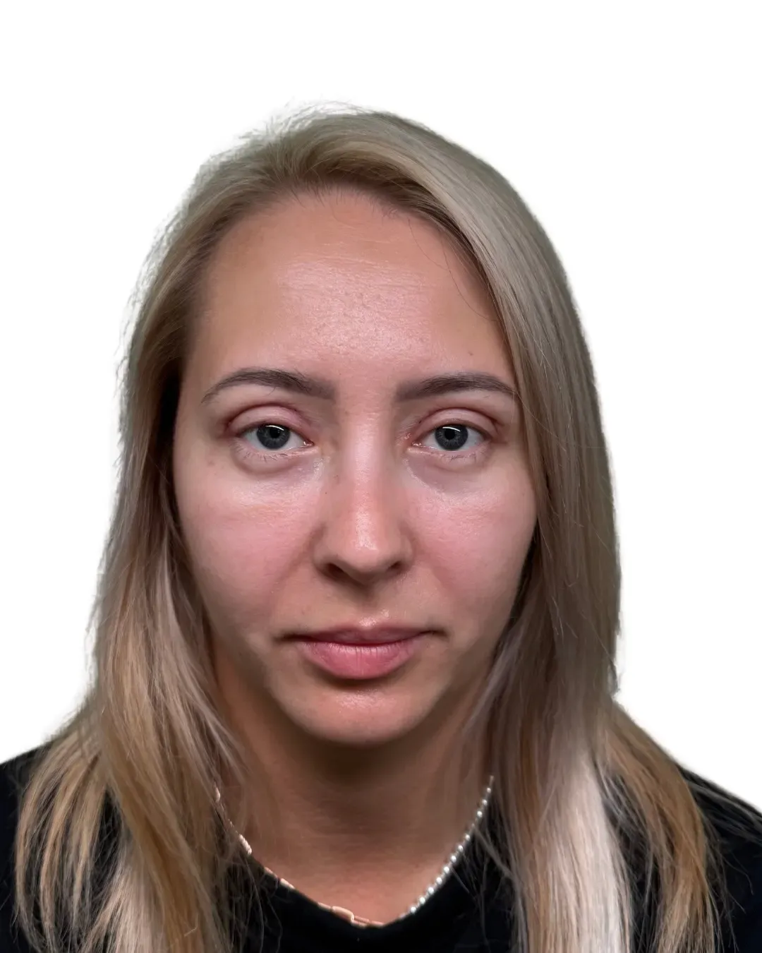 Po zabiegu — blefaroplastyka powiek, ujęcie na wprost