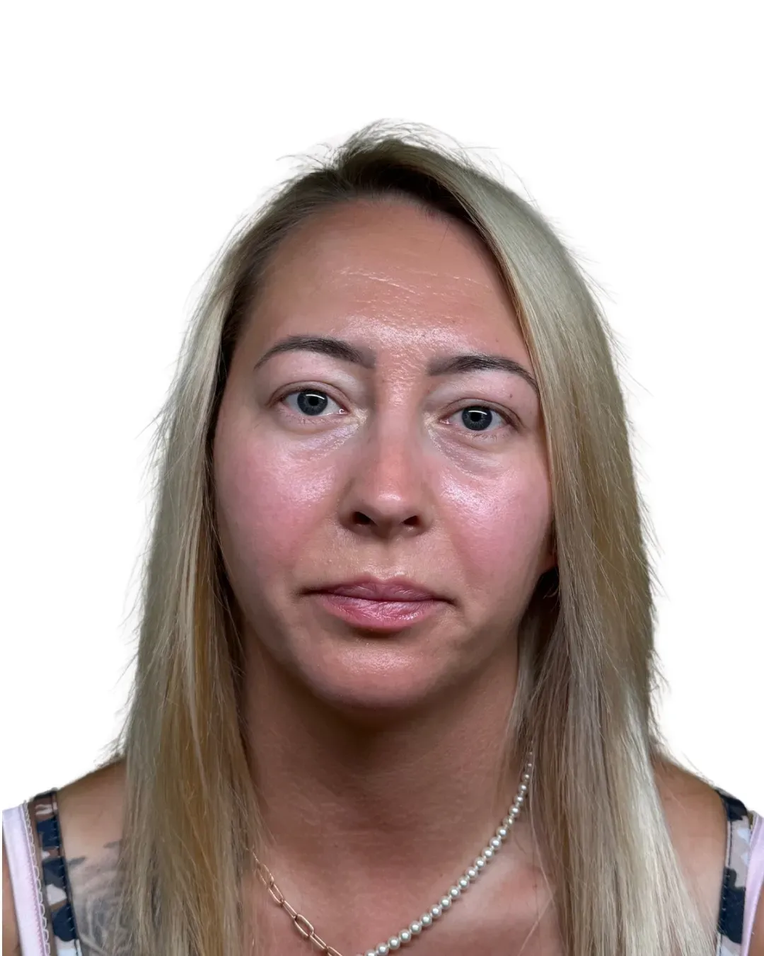 Przed zabiegiem — blefaroplastyka powiek, ujęcie na wprost